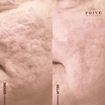 ACNE SCAR REJUVENATION