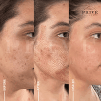 ACNE SCAR REJUVENATION