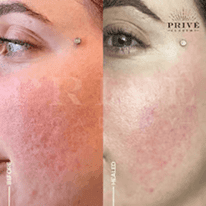 ACNE SCAR REJUVENATION