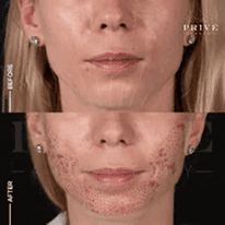 ACNE SCAR REJUVENATION