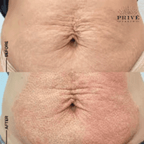 BELLY AREA