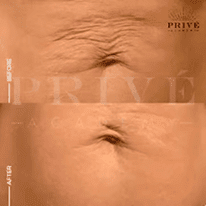 BELLY AREA