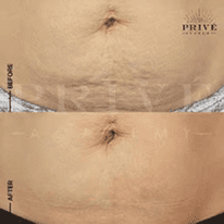BELLY AREA