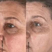 EYE AREA