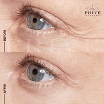 EYE AREA