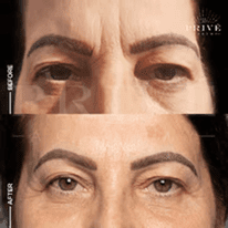 EYE AREA