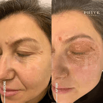 EYE AREA
