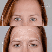 FOREHEAD AREA