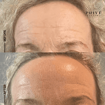 FOREHEAD AREA