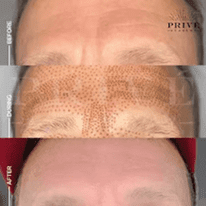 FOREHEAD AREA