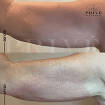 HANDS TIGHTENING REJUVENATION