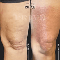 KNEE TIGHTENING