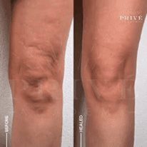 KNEE TIGHTENING