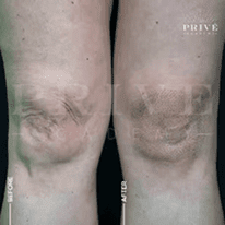 KNEE TIGHTENING
