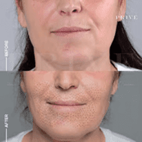LOWER FACE AREA