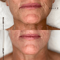 LOWER FACE AREA