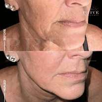 LOWER FACE AREA