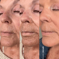 LOWER FACE AREA
