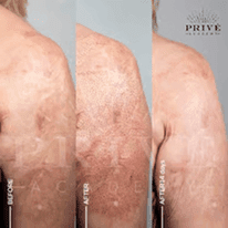 SCAR REJUVENATION