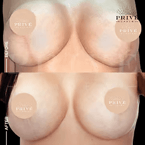 SCAR REJUVENATION
