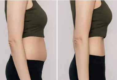Weight loss After-Before Slider 2