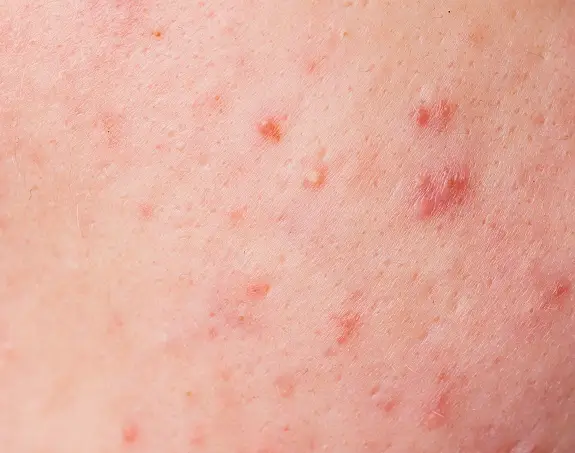 Common Side Effects