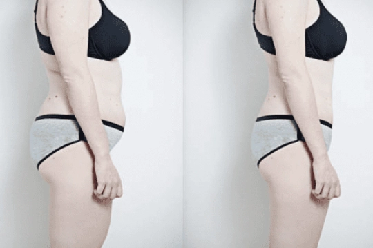 Medical weight loss result